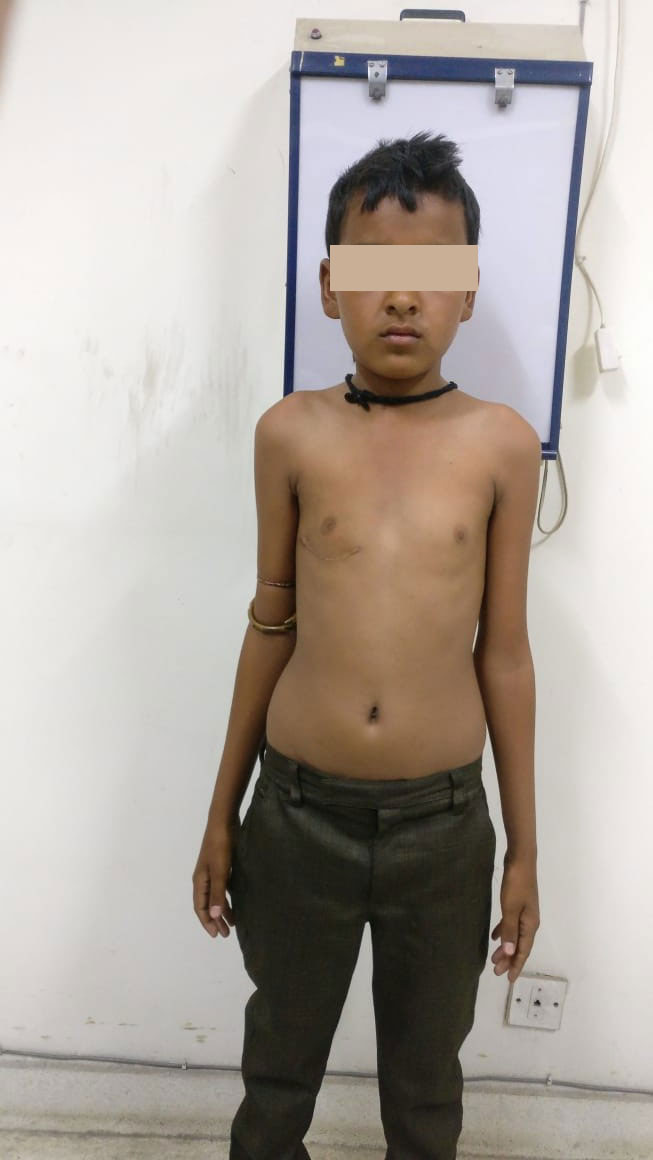 AV Canal Defect surgical photo