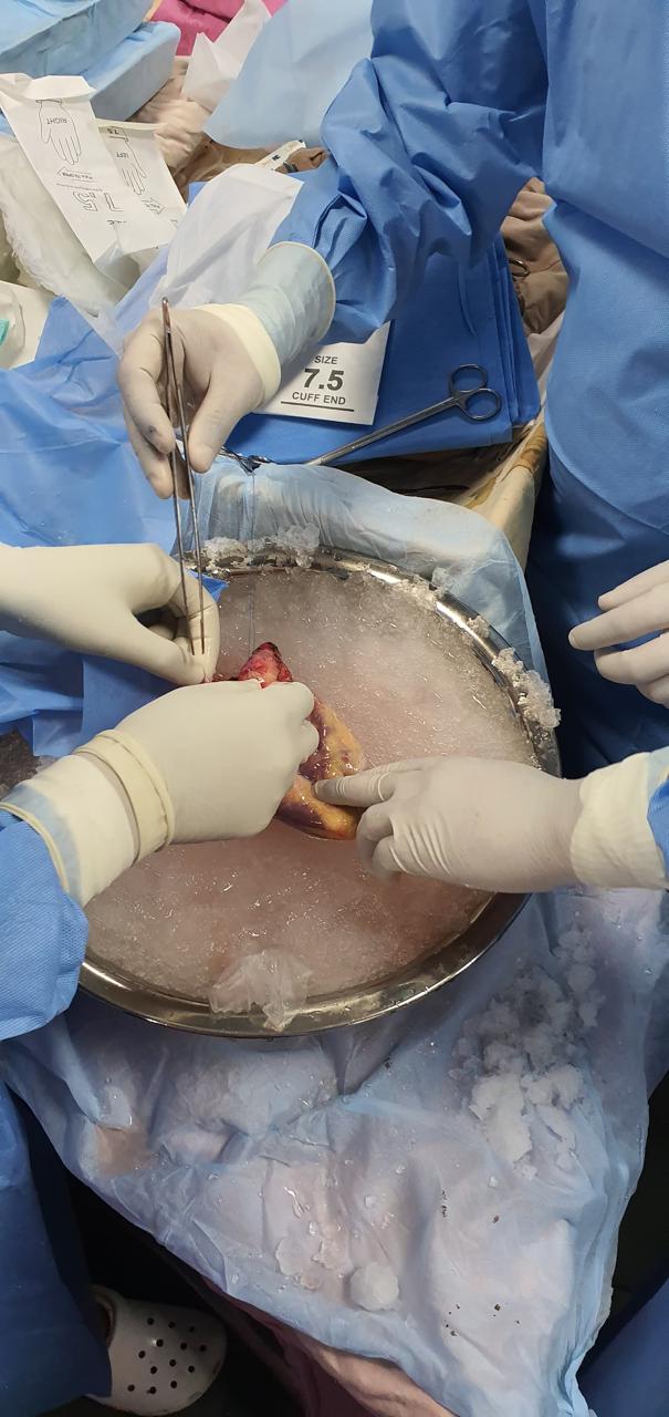 Heart Transplant surgical photo