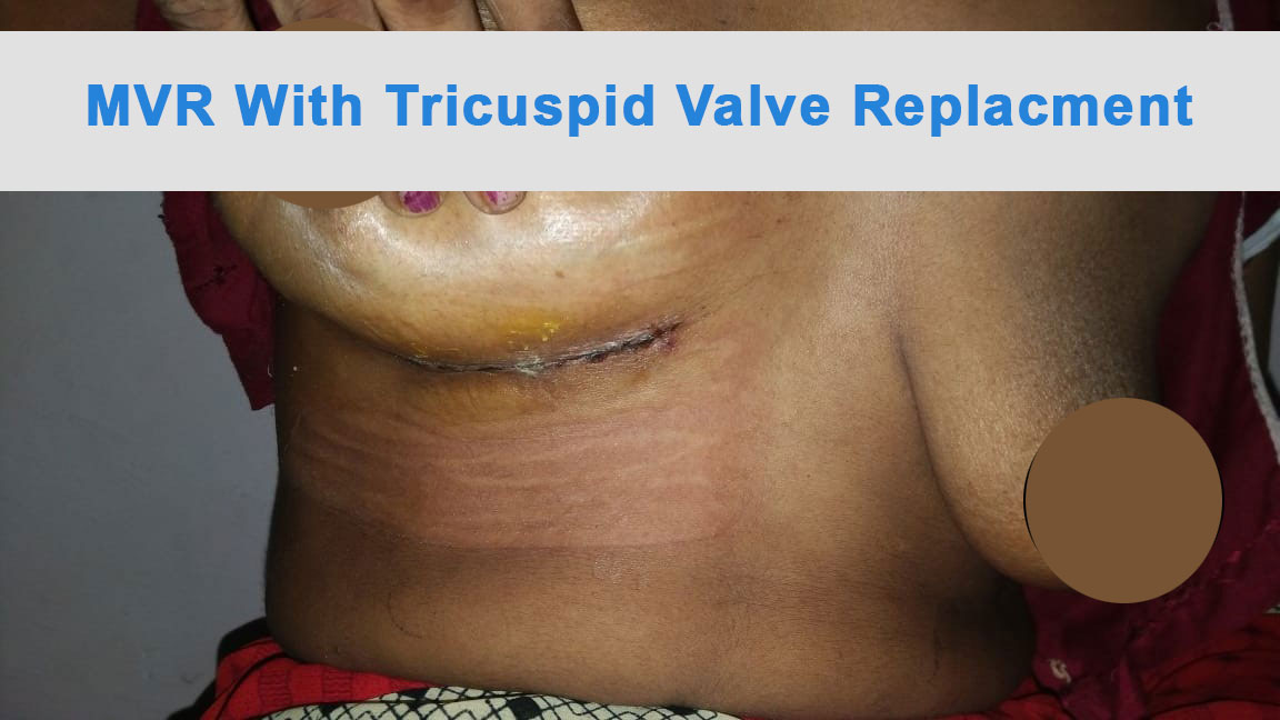 MVR - Mitral Valve Replacement surgical photo