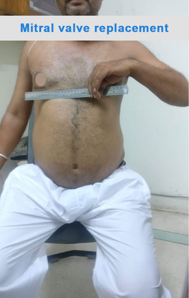 MVR - Mitral Valve Replacement surgical photo