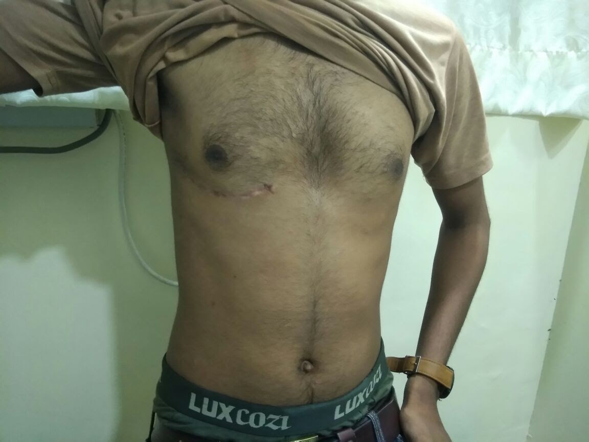 MVR - Mitral Valve Replacement surgical photo